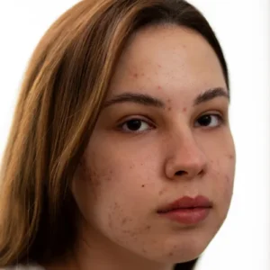 Tratament pete pigmentare fata